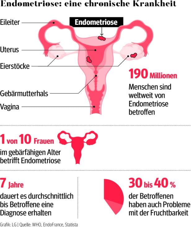 Endometriose: Das unentdeckte Leiden der Frau