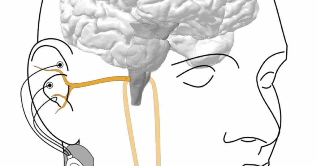 Nervenstimulation: Wenn das Gehirn nicht immer zuhört