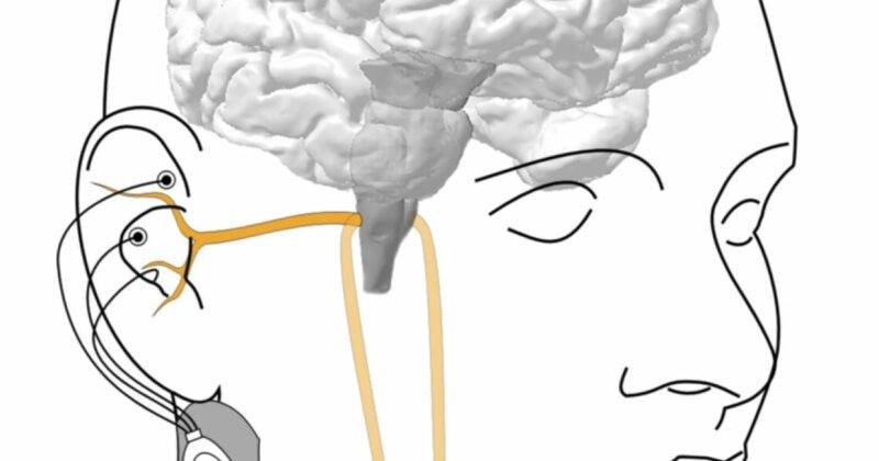 Nervenstimulation: Wenn das Gehirn nicht immer zuhört