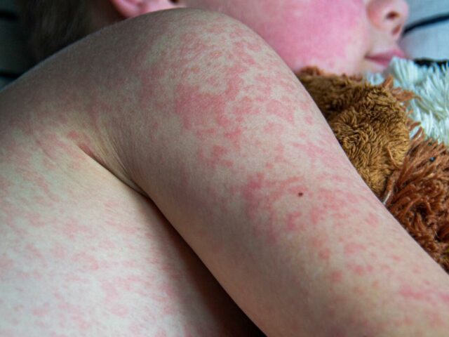 Bereits 3 Tote: Schlimmste Masern-Epidemie seit mehr als 30 Jahren