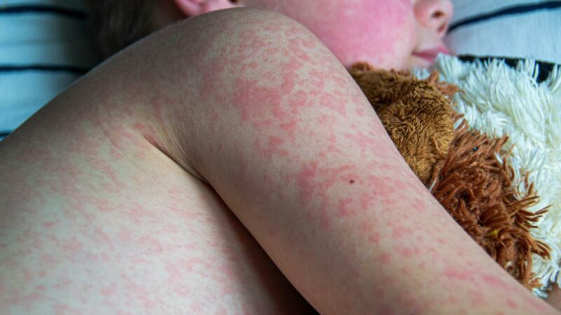 Bereits 3 Tote: Schlimmste Masern-Epidemie seit mehr als 30 Jahren